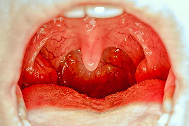 7 Myths About Tonsillectomy [Podcast 76] | Doctor Steven Y. Park, MD | New  York, NY